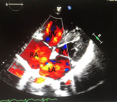 Frontiers Case Report Conquer A Complex Variant Coronary Pulmonary