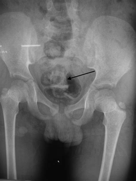 Plain Abdominal Radiograph Demonstrating A Large Recurrent Bladder