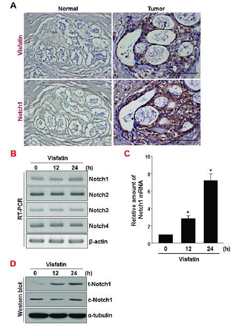 Analysis Of Visfatin And Notch Expression In Human Breast Tumor