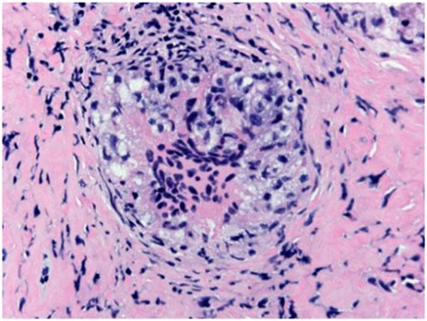 Neurosarcoidosis Involving Dura Matter H E Compact Collection Of