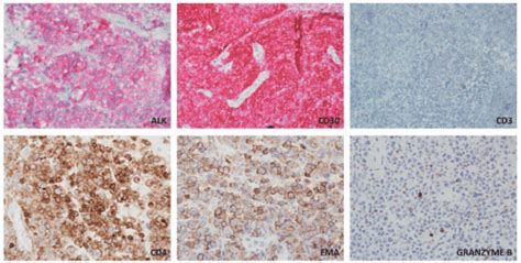 Cutaneous Hematolymphoid Proliferations Plastic Surgery Key