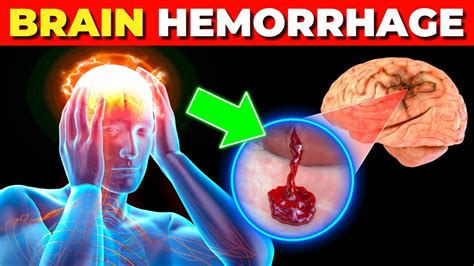 What Happens In Brain Hemorrhage Symptoms Causes And Treatment