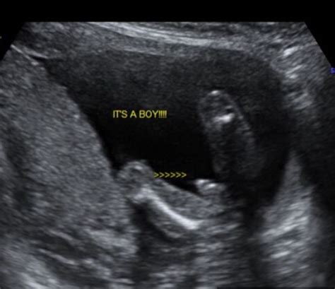 Determine The Sex Of A Baby Girl With Ultrasounds Artofit