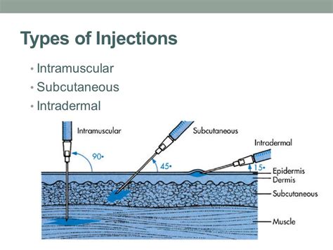 Study Medical Photos: Description Of Common Injection Sites