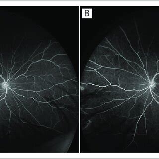 Optos Ultra Widefield Fluorescein Angiography In The Late Venous Phase