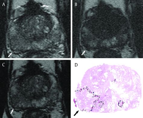 Good Conspicuity Of Prostate Cancer On T1 T2 Weighted Registered