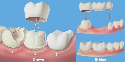 Crowns, Bridges and Implants - Vivid Dental | Vivid Dental