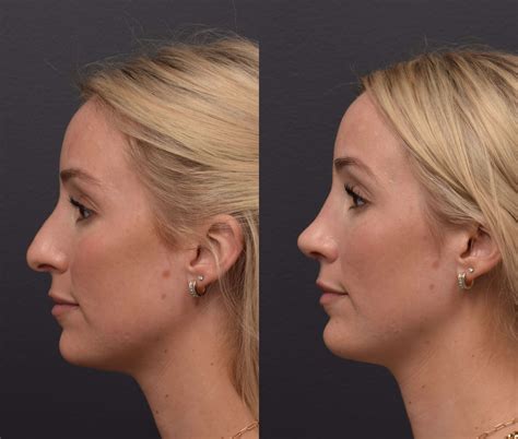 Rhinoplasty Menai