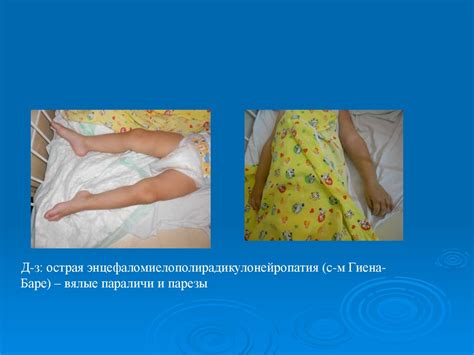 Острые вялые параличи - презентация онлайн