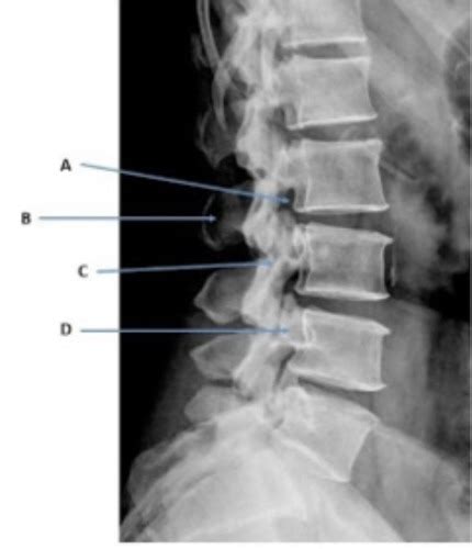 Chapter 9 Lumbar Spine Sacrum And Coccyx Flashcards Quizlet