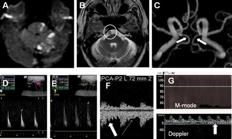 Reversed Flow In The Basilar Artery In Acute Vertebrobasilar Ischemia