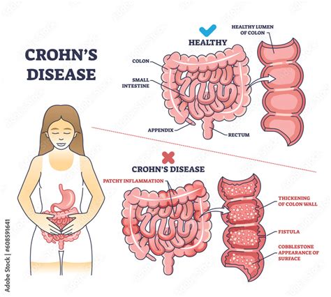 Crohns Disease As Inflammatory Bowel Problem Explanation Outline