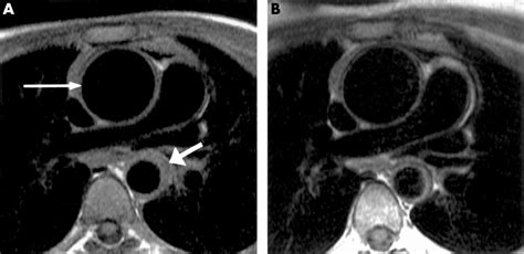 Magnetic Resonance Imaging In The Diagnosis And Follow Up Of Takayasu S