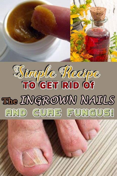 7 Home Remedies for Ingrown Nails ideas | ingrown nail, remedies ...