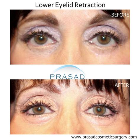 Eyelid Surgery Blepharoplasty Revision Specialist Dr Prasad