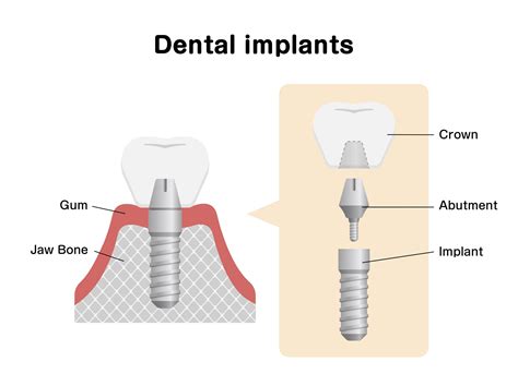 Dentist Portland Maine Inspire Dental Of Maine