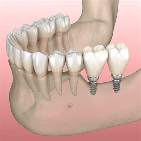 Mini Dental Implants Houston Tx Missing Teeth Oral Surgeon