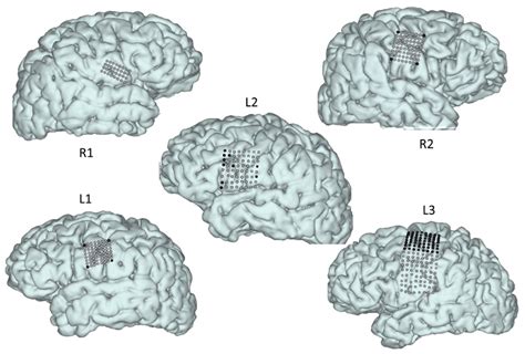 Decoding Spoken Phonemes From Sensorimotor Cortex With High Density