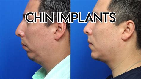 Chin Implants Youtube