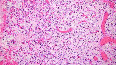 Pathology Outlines Hemangioblastoma