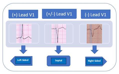 Ablation Of Accessory Pathways Indications And Contraindications