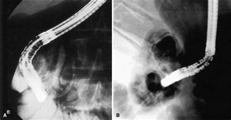 Ercp Pancreatogram From The Major Duodenal Papilla Show An Annular Download Scientific Diagram