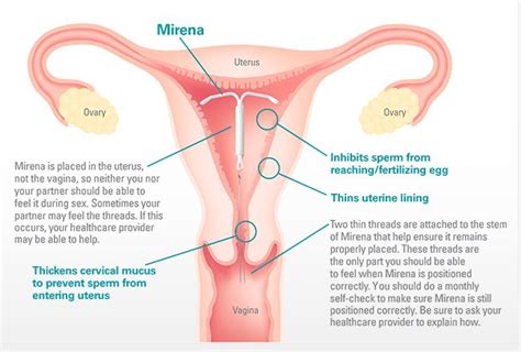 Intrauterine Device (IUD) - MacArthur Medical Center