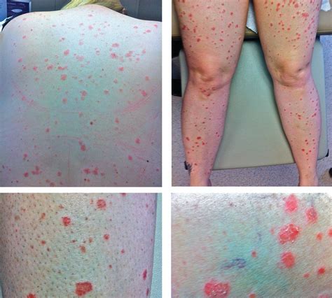 A Rash After Streptococcal Infection Mdedge