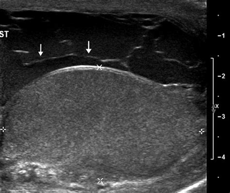 Testicular Rupture Ultrasound