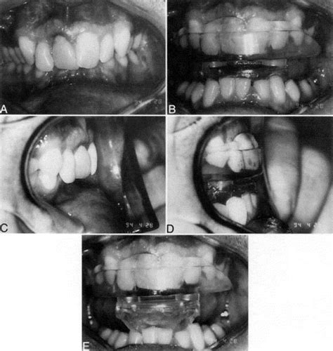 Comparison Of Two Dental Devices For Treatment Of Obstructive Sleep