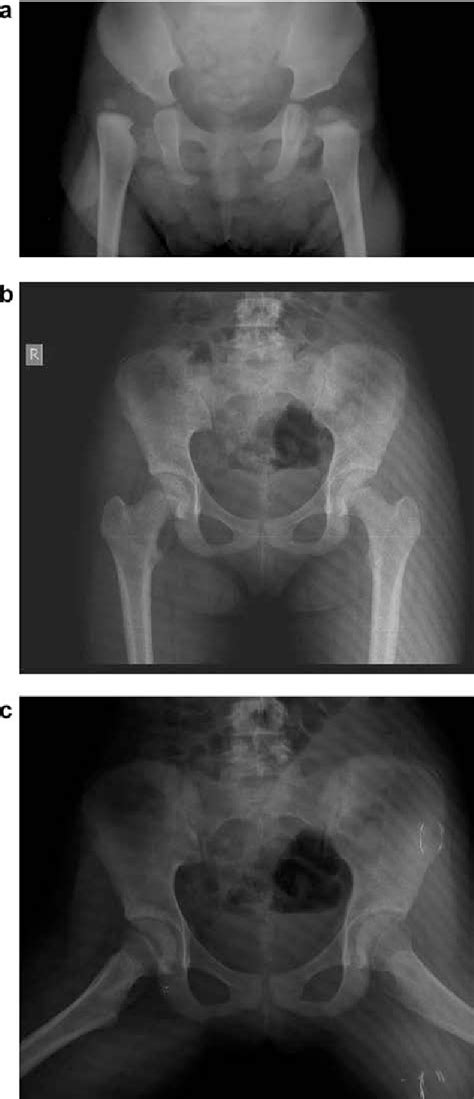 Figure From Radiological And Clinical Outcomes Of Medial Approach