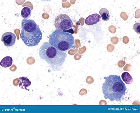 Multiple myeloma stock photo. Image of medical, cells - 310689844