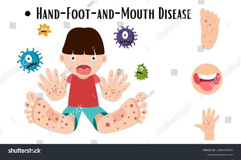 Hand Foot And Mouth Disease Hfmd With Royalty Free Stock Vector