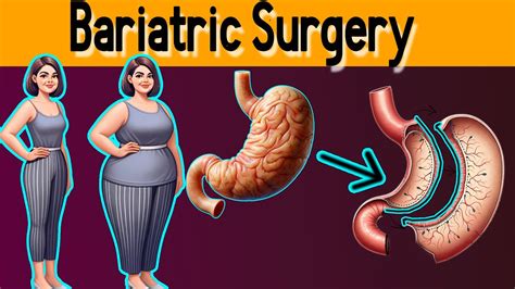 Weight Loss Surgery Types Top 5 Bariatric Surgery Youtube