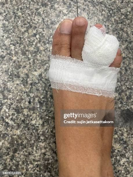 Feet Lesions Photos And Premium High Res Pictures Getty Images