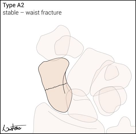 Radiopaedia Case Herbert And Fisher Classification Of Scaphoid