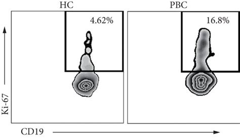 Cd Cd Hicd Hi B Cells Were Highly Proliferative From Pbc Patients