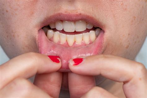 Will Receded Gums Grow Back The Surprising Answer