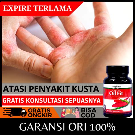 Jual Obat Kusta Herbal Penyakit Lepra Basah Dan Kering Infeksi Bakteri