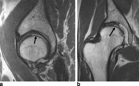 Torn Hip Labrum MRI