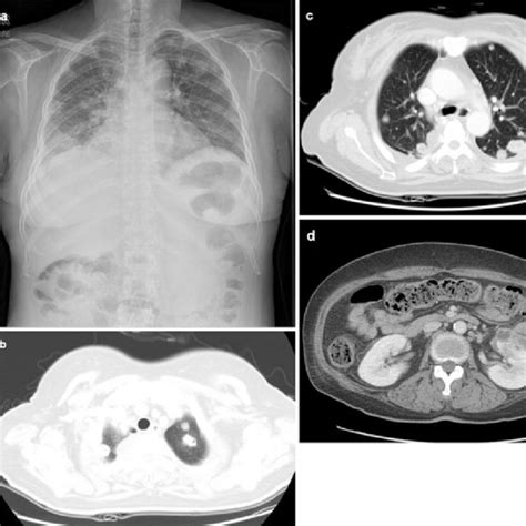 Chest X Ray A Shows Multiple Nodular Opacities In Both Lung Fields Download Scientific