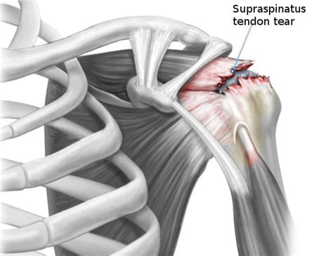 Rotator Cuff Injury StatPearls NCBI Bookshelf