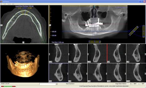 Achieve Dental Perfection Full Arch Dental Implants And The Role Of