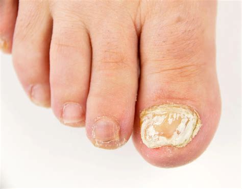 White Superficial Onychomycosis Nailknowledge