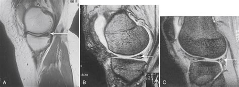 Meniscal Injuries Musculoskeletal Key