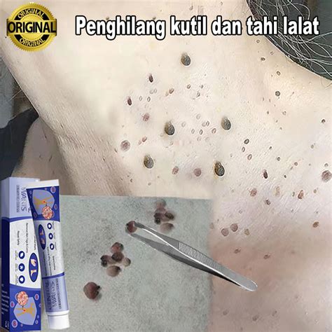 Jual Obat Penghilang Kutil Dan Tahi Lalat Skin Tag Remover Obat Kutil