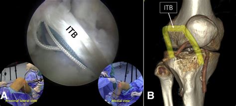 The Pedicled Iliotibial Band Is Transferred Into The Joint For Lateral