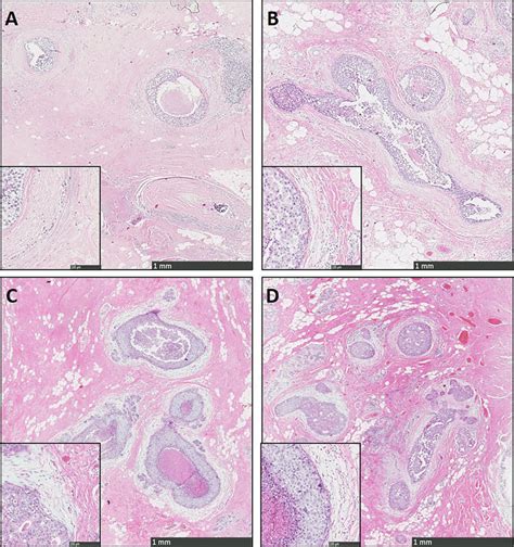 Examples Of Sclerotic A B And Myxoid D E Stroma At Download