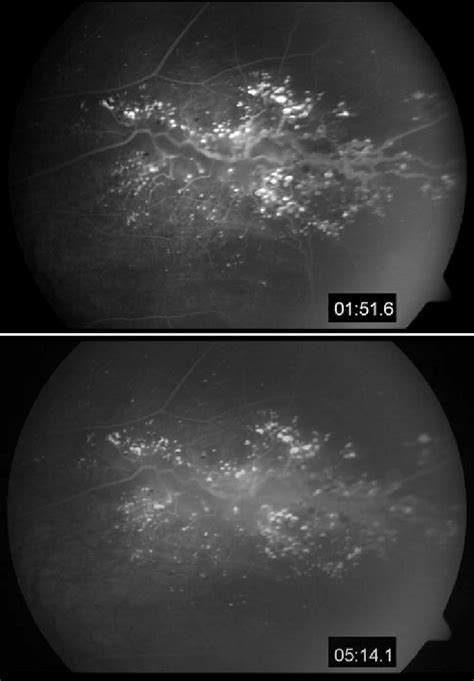 Fluorescein Angiography Top Early Phase Bottom Late Phase Download Scientific Diagram