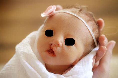 Edwards Syndrome Good Health